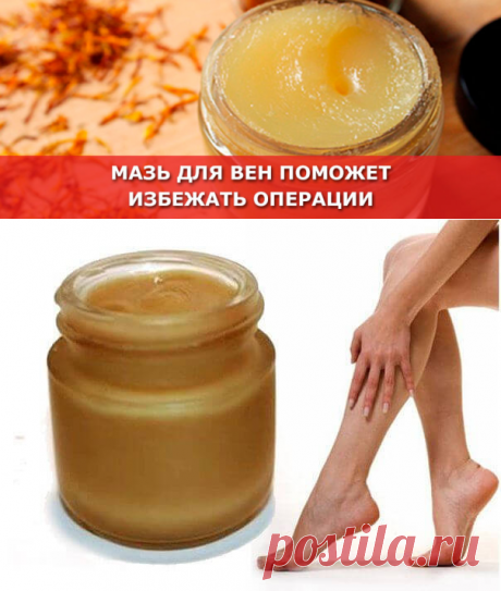 Мазь для вен поможет избежать операции - Женские Секреты
