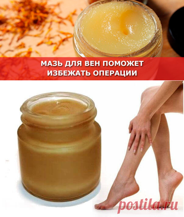 Мазь для вен поможет избежать операции - Женские Секреты