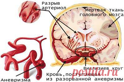 Сегодня день борьбы с инсультом!
В большинстве случаев инсульты являются осложнением гипертонической болезни и атеросклероза, реже они обусловлены болезнями клапанного аппарата сердца, инфарктом миокарда, врожденными аномалиями сосудов мозга, геморрагическими синдромами и артериитами.
Выделяют также так называемый малый инсульт, или инсульт с обратимым неврологическим дефицитом, при котором все очаговые симптомы исчезают через 3 нед.
Узнайте о симптомах заболевания и острых поражения сосудов