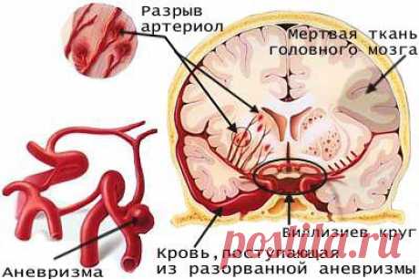 Сегодня день борьбы с инсультом!
В большинстве случаев инсульты являются осложнением гипертонической болезни и атеросклероза, реже они обусловлены болезнями клапанного аппарата сердца, инфарктом миокарда, врожденными аномалиями сосудов мозга, геморрагическими синдромами и артериитами.
Выделяют также так называемый малый инсульт, или инсульт с обратимым неврологическим дефицитом, при котором все очаговые симптомы исчезают через 3 нед.
Узнайте о симптомах заболевания и острых поражения сосудов