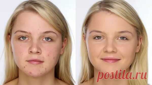 Маскируем прыщик - лёгкий способ