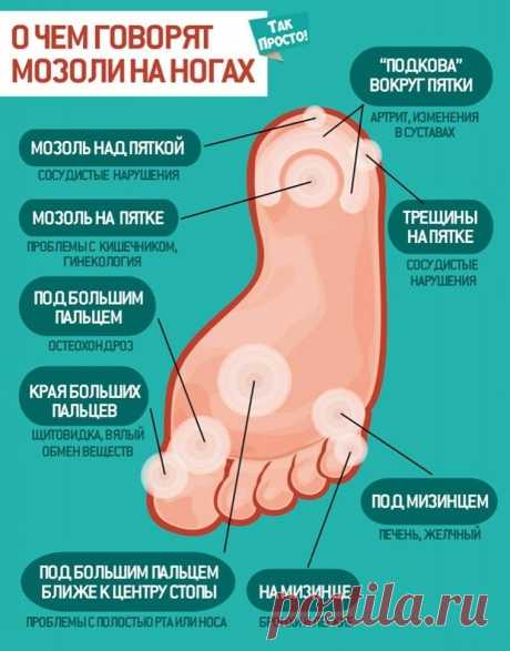 О чем говорят мозоли на ногах