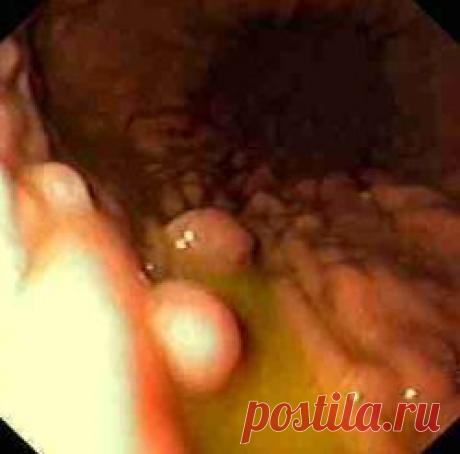 Полипы желудка - причины, симптомы, диагностика и лечение