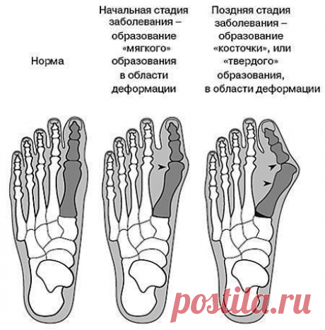 Как вылечить косточку на ноге.