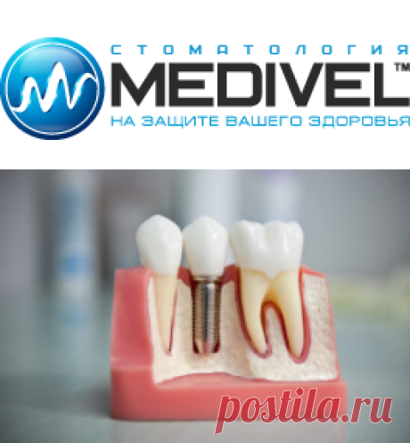 Имплантация зубов | MEDIVEL | MEDIVEL