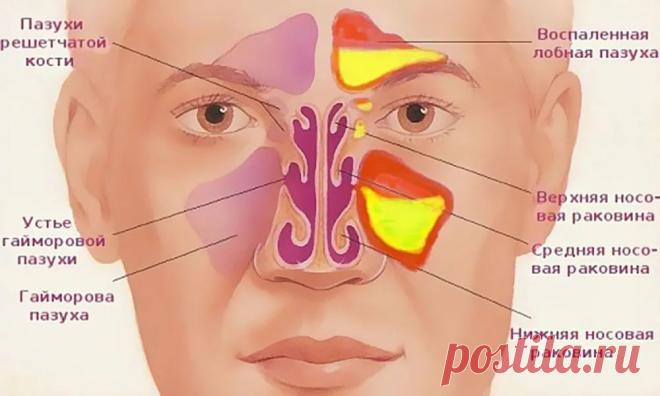 Легко очистите гайморовые и лобные пазухи от гноя и слизи! Хронический гайморит и синусит могут не только быть причиной частых головных болей, но и являются источником инфекции, которая с током крови может разноситься по всему организму и вызывать заболевания других органов.