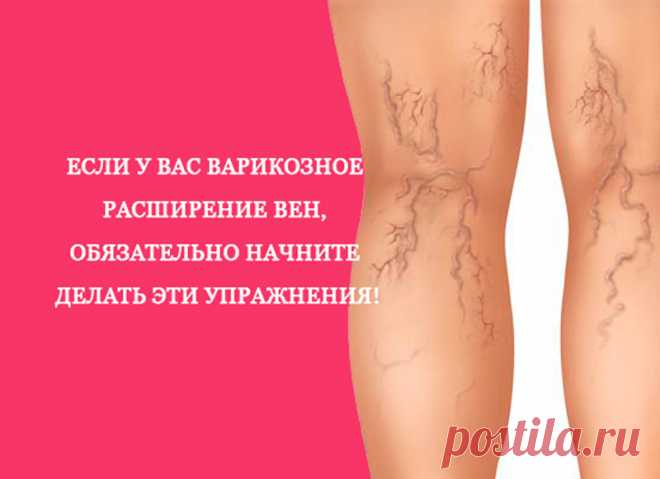 Упражнения при варикозном расширении вен Если диагноз ВАРИКОЗНОЙ БОЛЕЗНИ поставлен, то для комплексного лечения этого заболевания целесообразно использовать специальный комплекс лечебных гимнастических УПРАЖНЕНИЙ.