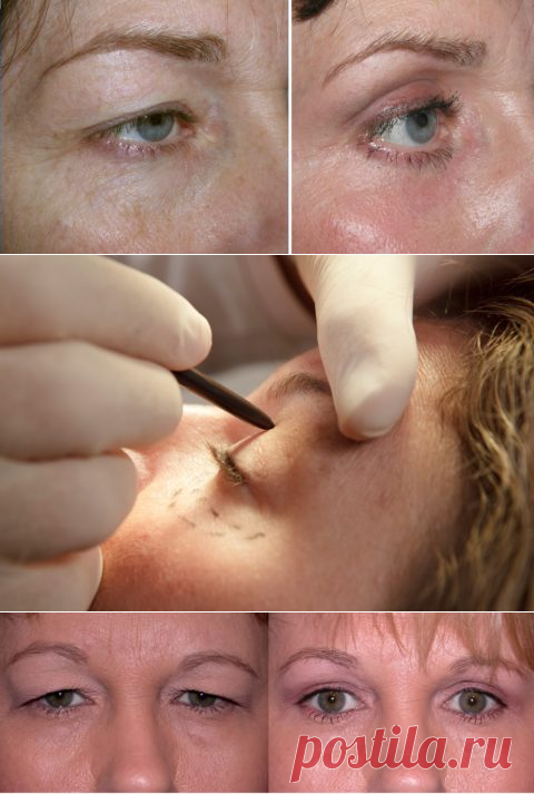 Блефаропластика верхних век, фото сразу после операции