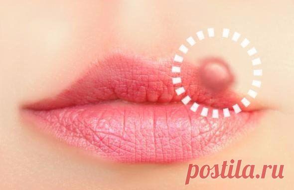 Женский журнал    НАТУР. СРЕДСТВА ПРОТИВ ГЕРПЕСА