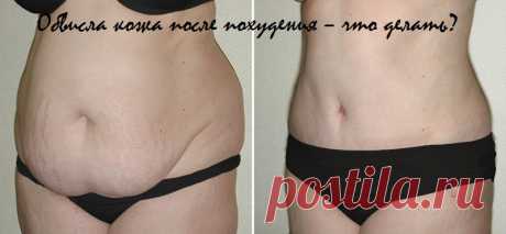 Обвисла кожа после похудения – что делать? | ocharowashka.ru