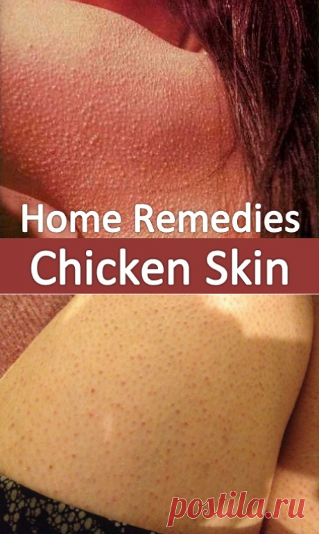 Home Remedies for Keratosis Pilaris (Bumps on the Skin) | Virtual Clinic