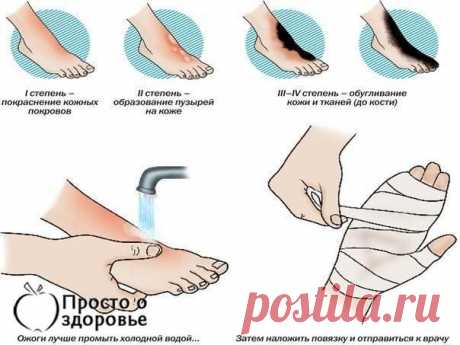 ПЕРВАЯ ПОМОЩЬ ПРИ ОЖОГАХ. 12 ХОРОШИХ СОВЕТОВ!