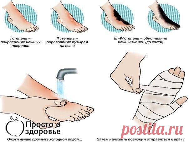 ПЕРВАЯ ПОМОЩЬ ПРИ ОЖОГАХ. 12 ХОРОШИХ СОВЕТОВ!