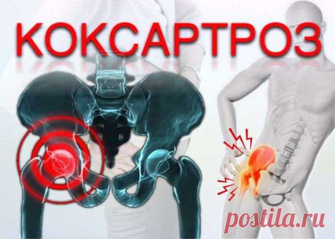 Коксартроз развивается постепенно, в течение нескольких лет. Сопровождается болями и ограничением движений в суставе. На поздних стадиях наблюдается атрофия мышц бедра и укорочение конечности.