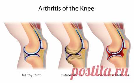 Технология эндопротезирования суставов