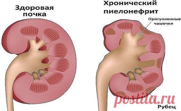 НАРОДНЫЙ РЕЦЕПТ ДЛЯ ЛЕЧЕНИЯ ПОЧЕК
Обязательно сохраните к себе на стену, чтобы не потерять!
Разбивает почечные камни, выводит песок из почек
Два кг. репчатого лука очистить от чешуи. Мелко порезать или перетереть на крупной терке. Смешать с двумя кг. сахарного песка. Томить два часа на медленном огне, помешивая, чтобы не пригорел! Вместо кастрюли прекрасно томить в скороварке. Получается 2 – 2,5 литра янтарной массы. Разложить по банкам.
Одну на стол – чтобы не забывать о ...