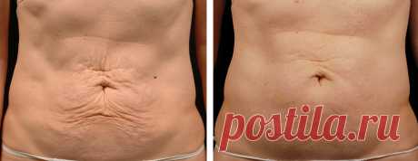 Проблема обвисшей кожи стоит особенно остро у людей после похудения и до него. Как показывает практика, придать коже прежний вид совсем не просто, а для некоторых просто не выполнимо.
Все эти средства не требуют больших затрат и приобрести их можно в каждой аптеке.