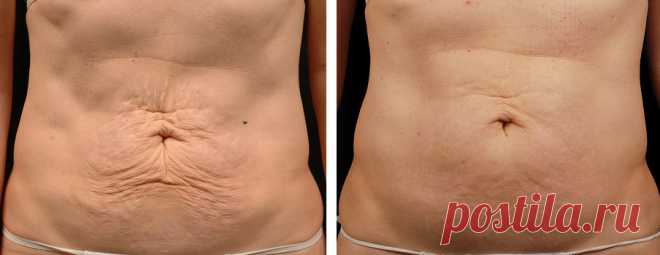 Проблема обвисшей кожи стоит особенно остро у людей после похудения и до него. Как показывает практика, придать коже прежний вид совсем не просто, а для некоторых просто не выполнимо.
Все эти средства не требуют больших затрат и приобрести их можно в каждой аптеке.