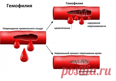 Признаки повышенной вязкости крови: симптомы, диагностика и лечение Узнайте о признаках повышенной вязкости крови и связанных с ней заболеваниях.