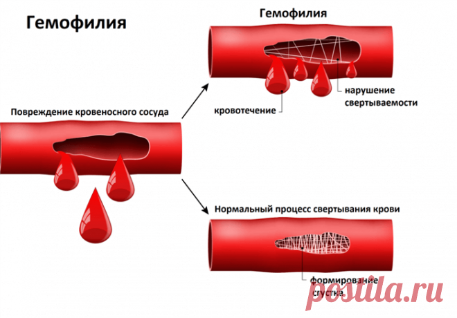 Признаки повышенной вязкости крови: симптомы, диагностика и лечение Узнайте о признаках повышенной вязкости крови и связанных с ней заболеваниях.