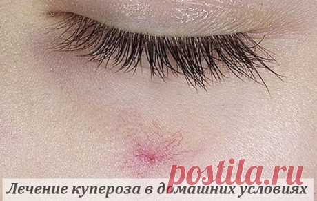 КАК ИЗБАВИТЬСЯ ОТ КУПЕРОЗА?