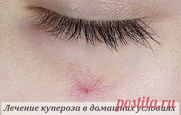 КАК ИЗБАВИТЬСЯ ОТ КУПЕРОЗА?