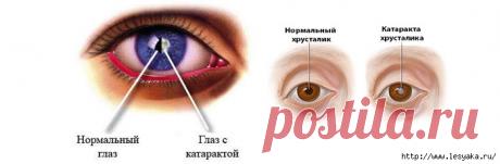 Причины и профилактика катаракты