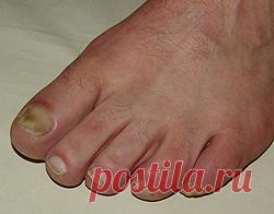 Вросший ноготь на ноге, пяточная шпора, ногтевой грибок. Причины, методы и лечение вросшего ногтя народными средствами