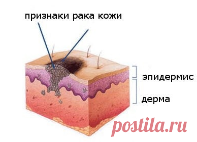 Рак кожи