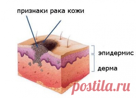 Рак кожи