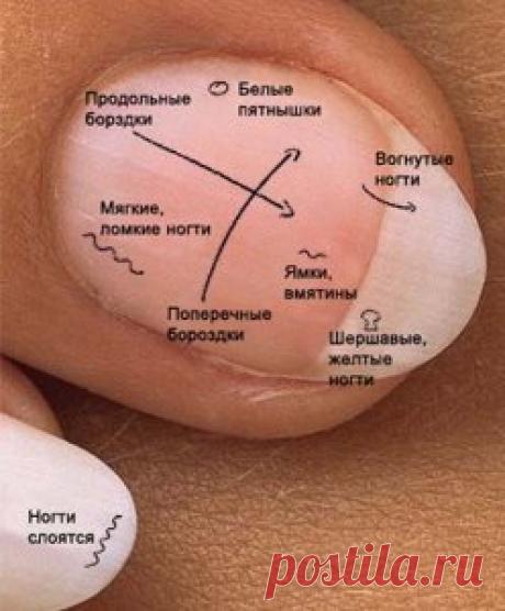 Значение отметок на ногтях.