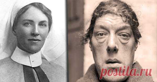 История «самой уродливой женщины в мире», которая после редкой болезни из красавицы превратилась в посмешище | Люблю Себя