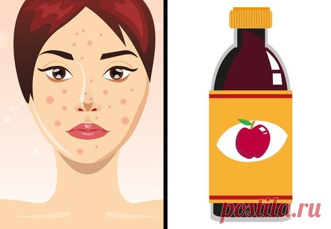 8 средств, которые мгновенно избавляют от пигментных пятен, шрамов, прыщей!.. - Ok'ейно.plus