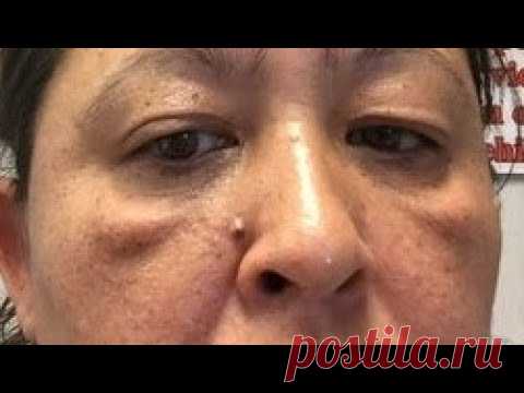 Малярные мешки. Своими руками убрать скуловые мешки и отеки.