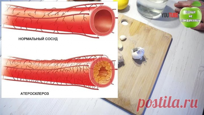 Старинный рецепт для расчистки Ваших артерий. Улучшаем кровоснабжение всех органов: очищаются сосуды