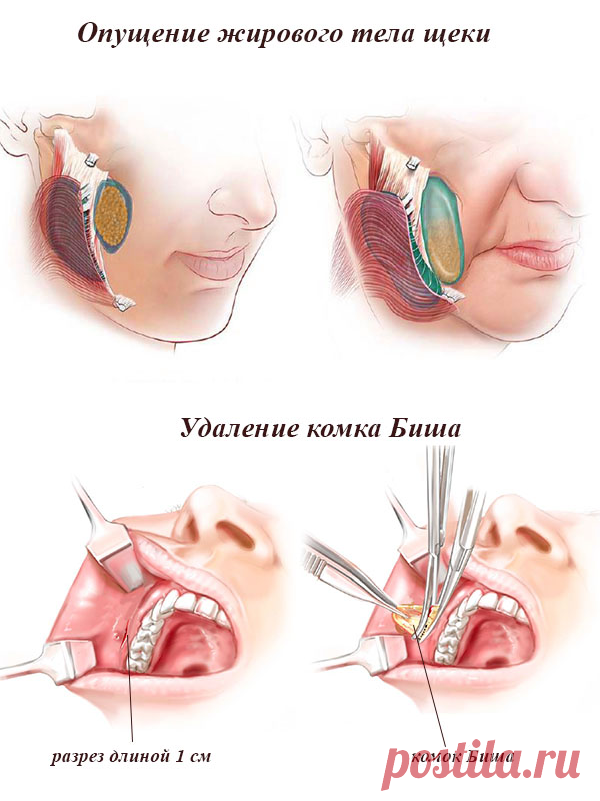 Удаление комков Биша: что это за операция?