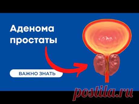 Аденома простаты | Гиперплазия предстательной железы