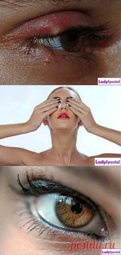 Как убрать ячмень с глаза? - Женский журнал LadySpecial.ru