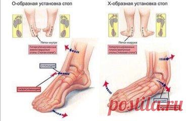 Что происходит при плоскостопии? 
️Человеческая стопа обладает уникальным свойством — она работает как амортизатор, то есть пружинит. Ни одно, даже самое высоко прыгающее и быстро бегающее животное, типа кенгуру или ягуара, не может похвастаться этой удивительной способностью. Пружинит стопа за счет конструкции свода, которую поддерживает система связок и мышц. Когда этот мышечно-связочный механизм по каким-то причинам ослабевает, развивается плоскостопие.
Уплощенная стопа...