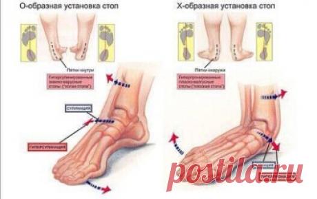 Что происходит при плоскостопии? 
️Человеческая стопа обладает уникальным свойством — она работает как амортизатор, то есть пружинит. Ни одно, даже самое высоко прыгающее и быстро бегающее животное, типа кенгуру или ягуара, не может похвастаться этой удивительной способностью. Пружинит стопа за счет конструкции свода, которую поддерживает система связок и мышц. Когда этот мышечно-связочный механизм по каким-то причинам ослабевает, развивается плоскостопие.
Уплощенная стопа...