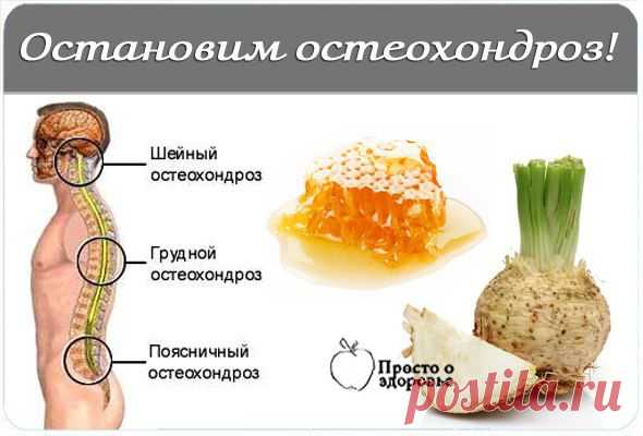 Остановим остеохондроз | Женский журнал