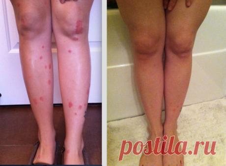Эффективное домашнее лечение псориаза