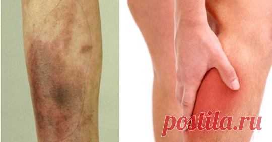 9 проблем со здоровьем ног, которые могут сигнализировать о серьезной болезни В какой-то момент в жизни каждый испытал незначительные проблемы со здоровьем ног, таких как мышечные судороги. Часто мы сталкиваемся с этими проблемами во время занятий спортом. Тем не менее, бывают …