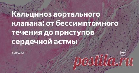 Кальциноз аортального клапана: от бессимптомного течения до приступов сердечной астмы Внимание к этой проблеме только набирает обороты, что обусловлено высокой распространённостью кальциноза аортального клапана среди пациентов старшего возраста