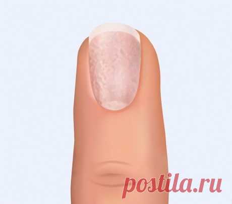 11 вещей, которые могут рассказать ногти о нашем здоровье Белые пятнышки на ногтях Вероятная причина: травма. Маленькие белые пятнышки на ногтях не представляют угрозы и обычно появляются в результате небольшой травмы. В других случаях они могут сигнализировать о недостатке витаминов Горизонтальные белые линии Вероятная причина: травма или недостаток цинка. Горизонтальные линии, как и пятнышки, могут возникать в результате травмы ногтевой пластины или при недостатке цинка и кальция. В более…