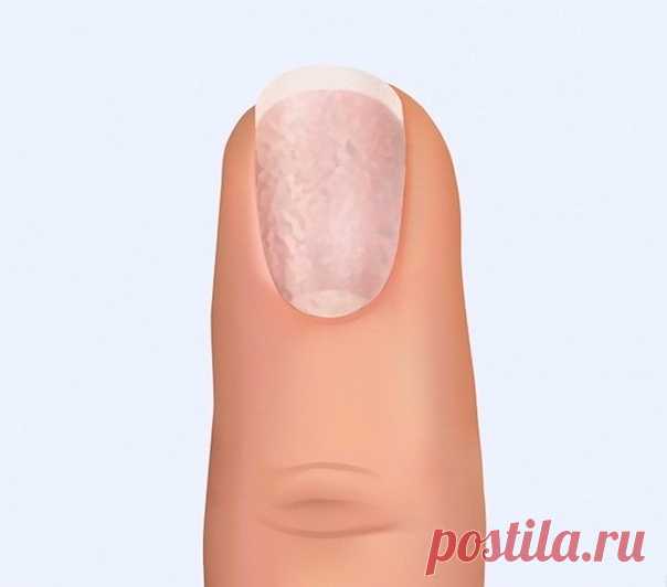 11 вещей, которые могут рассказать ногти о нашем здоровье Белые пятнышки на ногтях Вероятная причина: травма. Маленькие белые пятнышки на ногтях не представляют угрозы и обычно появляются в результате небольшой травмы. В других случаях они могут сигнализировать о недостатке витаминов Горизонтальные белые линии Вероятная причина: травма или недостаток цинка. Горизонтальные линии, как и пятнышки, могут возникать в результате травмы ногтевой пластины или при недостатке цинка и кальция. В более…