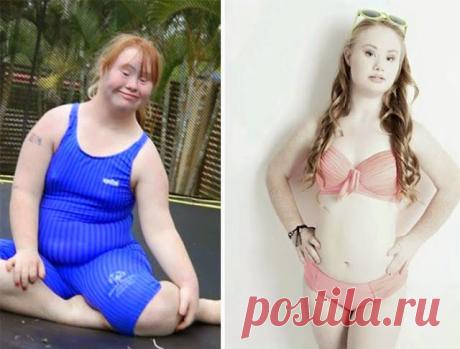 Похудев на 20 кг, 18-летняя девушка с синдромом Дауна решила стать моделью | Мамам, женщинам, бабушкам и очень любознательным.
