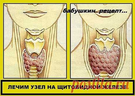 УЗЕЛ НА ЩИТОВИДКЕ !!!  **Смешай по 1ст молотой гречн/крупы, пропущенных через мясорубку грец/орехов, и мёд - в эмал/чистой посуде, затем в стекл/банку. *Приём: 1раз в неделю за целый день ешь эту смесь, не принимая больше никакой пищи, кроме воды! И так - 6раз, т. е. 6недель. Через месяц повтори. *Уже после 1го курса зоб уменьшится, а после 2го - болезнь оставит. Проверь на УЗИ: щитовидка будет в норме!