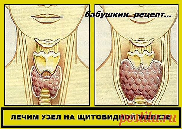 УЗЕЛ НА ЩИТОВИДКЕ !!!  **Смешай по 1ст молотой гречн/крупы, пропущенных через мясорубку грец/орехов, и мёд - в эмал/чистой посуде, затем в стекл/банку. *Приём: 1раз в неделю за целый день ешь эту смесь, не принимая больше никакой пищи, кроме воды! И так - 6раз, т. е. 6недель. Через месяц повтори. *Уже после 1го курса зоб уменьшится, а после 2го - болезнь оставит. Проверь на УЗИ: щитовидка будет в норме!