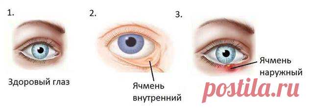 12 рецептов лечения ячменя на глазу. Если часто страдаете от этой напасти — применяйте, и проблем не знайте | Люблю Себя